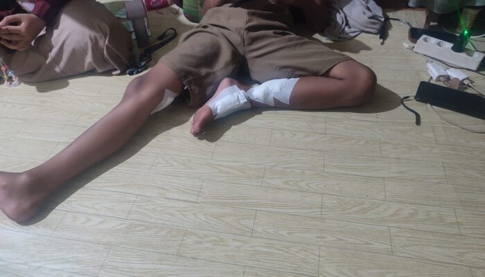 Diterkam Buaya saat Berenang, Bocah 10 Tahun di Bontang Selamat Dengan Luka Sobek 